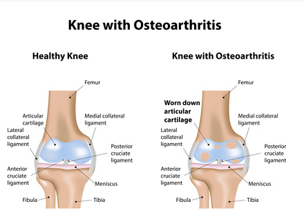 Knee Joint with arthritis symptoms 