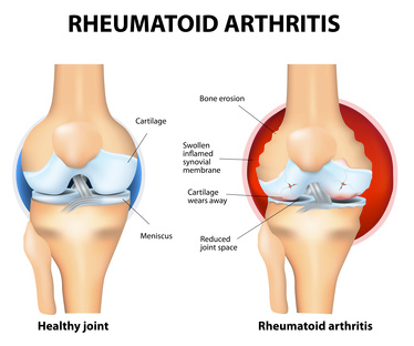 Rheumatoid Arthritis symptoms in the knees