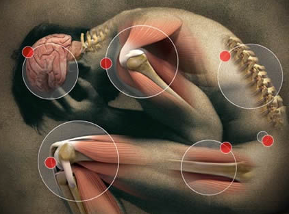 fibromyalgia arthritis symptoms areas