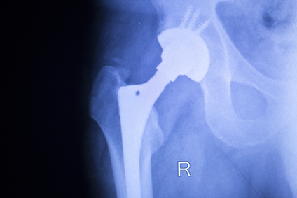 Metal Prostheses of the hip
