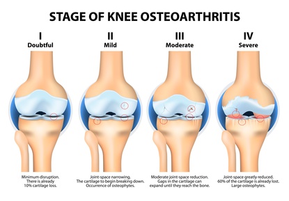 The four stages of osteoarthritis