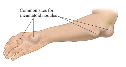 rheumatoid nodules which commonly show arthritis symptoms 