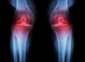 Osteoarthritis Self-Test confirmed by X-Ray